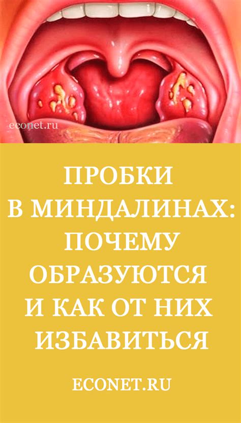 Профилактика глухой пробки: как предотвратить ее возникновение и сохранить слуховую систему в здоровом состоянии