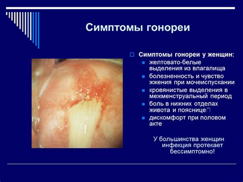 Профилактика гонореи у женщин