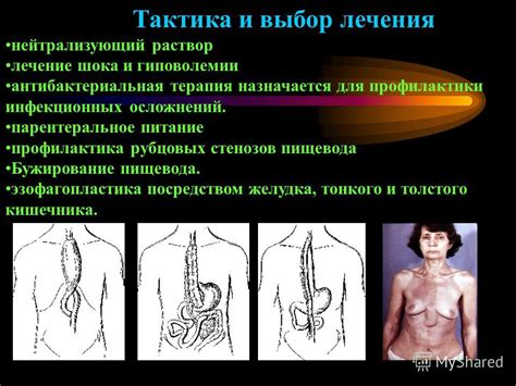 Профилактика грыжи пищевода