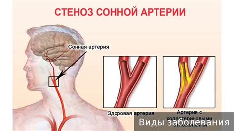 Профилактика изгиба сонной артерии