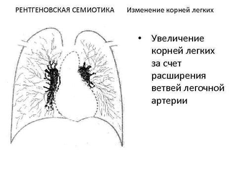 Профилактика и лечение расширения корней легких