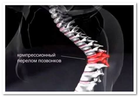 Профилактика и реабилитация после перелома позвоночника