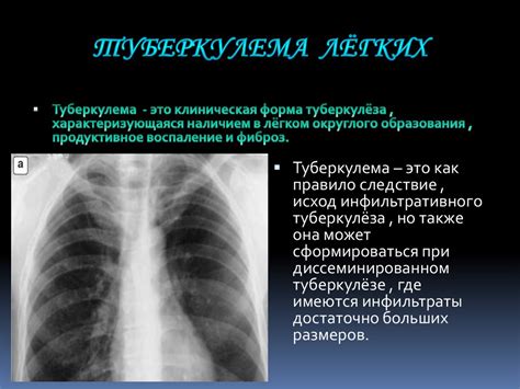 Профилактика метатуберкулезных изменений легких