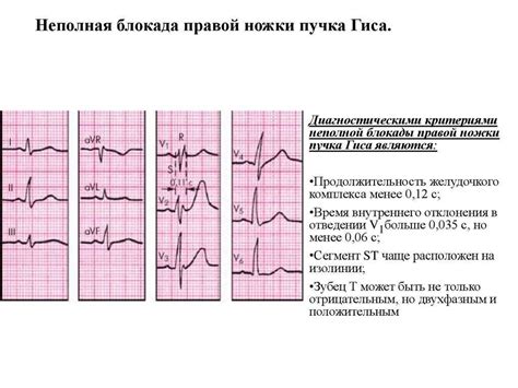 Профилактика неполной блокады правой ножки у детей