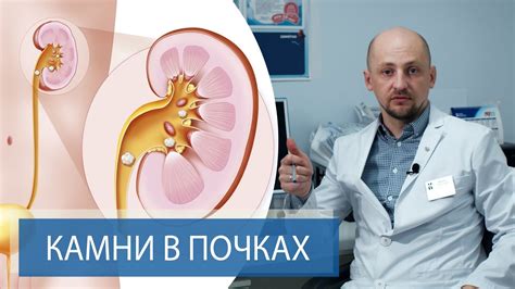 Профилактика образования микролитов на почках