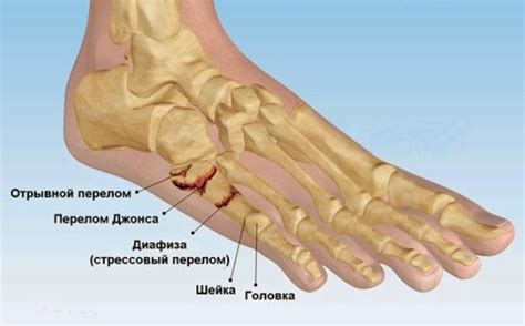 Профилактика плюсневой кости