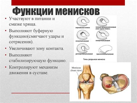 Профилактика порванного мениска