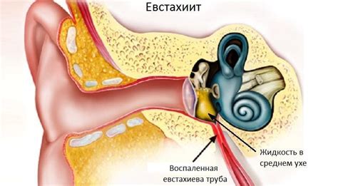 Профилактика правостороннего тубоотита