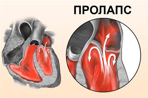 Профилактика пропуска клапана сердца