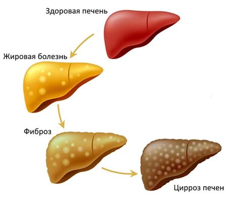 Профилактика развития цирроза печени