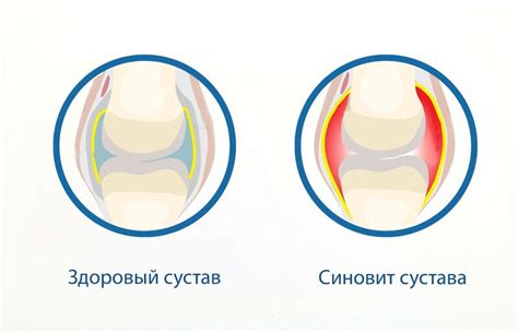 Профилактика синовита