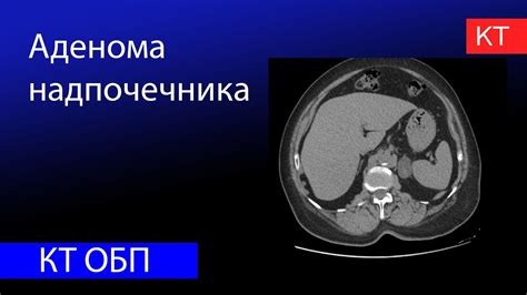 Профилактика увеличенного надпочечника