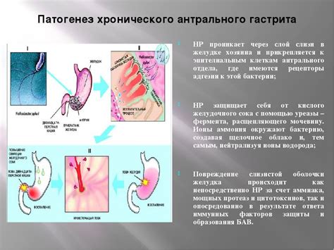 Профилактика хронического гастрита