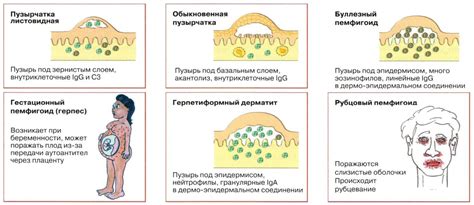 Профилактические меры при водянистых пузырях на теле