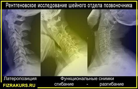 Процедура проведения функциональных снимков шейного отдела позвоночника