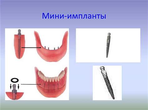 Процедура установки мини имплантов