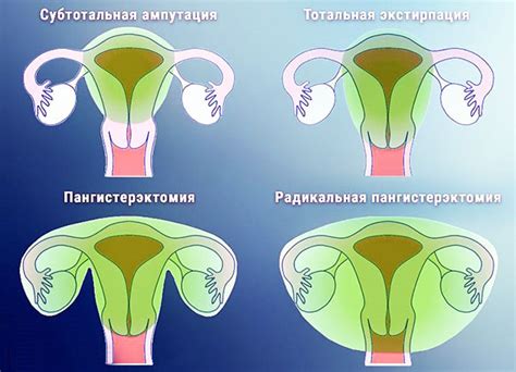 Процедуры восстановления после удаления матки