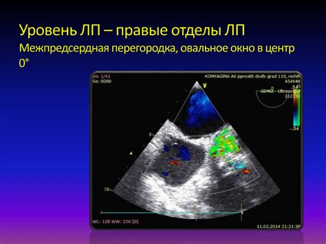 Процесс закрытия овального окна у новорожденных