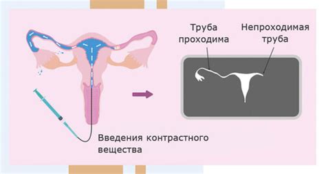 Процесс пластики маточных труб