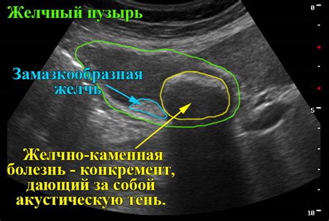 Процесс проведения УЗИ желчного пузыря с нагрузкой