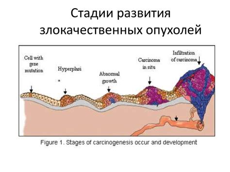 Процесс развития инкапсулированной опухоли