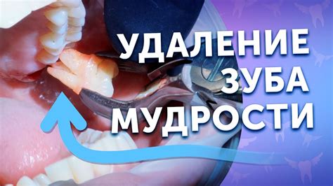 Процесс удаления мудреных зубов мудрости