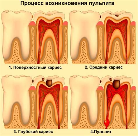 Процесс умерщвления зуба и его симптомы