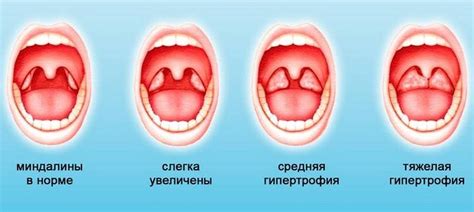 Прочистил горло: причины, симптомы и методы лечения