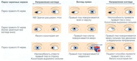 Проявление артифакий глаза