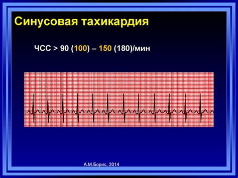 Проявление вертикальной эос синусовой тахикардии