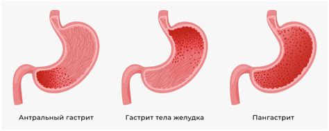 Проявления самоестествления желудка