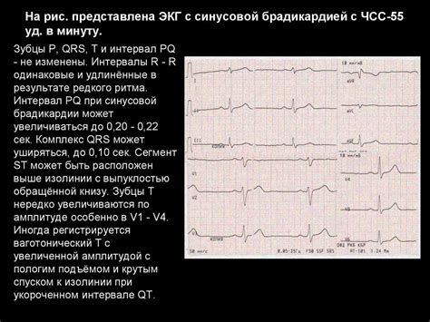 Проявления синусовой брадикардии у детей