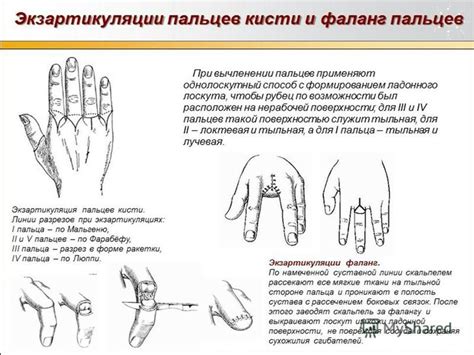 Психологическая интерпретация сновидения: ампутация правой кисти