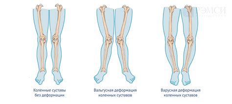 Психологические последствия прострела в колено