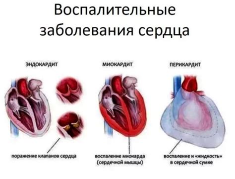 Психологические факторы лопнувшего сердца