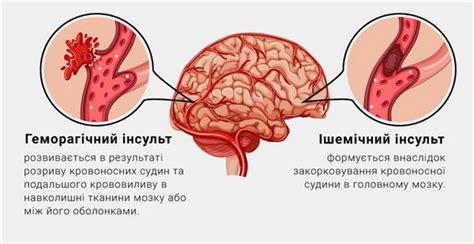 Пятая причина возникновения средней тяжести при инсульте