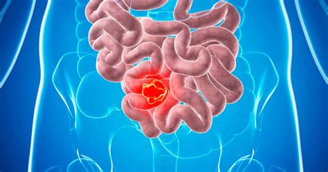 Развитие новообразования в кишечнике