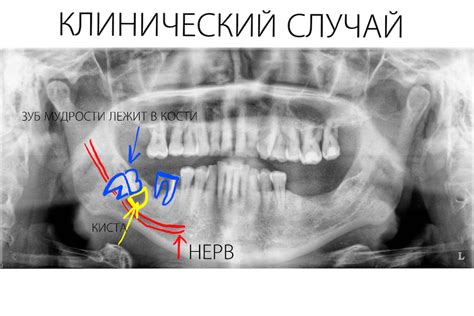 Различные интерпретации сна с потерей зуба без боли и крови