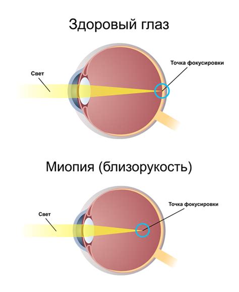 Различные методы коррекции миопии первой степени