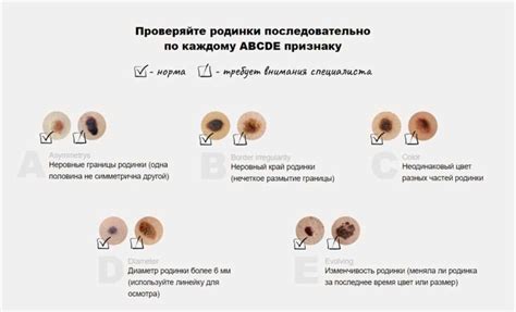 Различные типы родинок и их характеристики