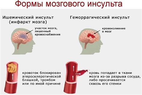 Разновидности инсульта и их симптомы