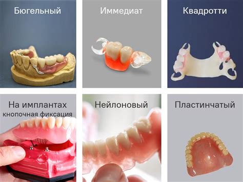 Разновидности съемных зубных протезов и их преимущества