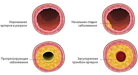 Разрушение сосудов и кровоизлияния