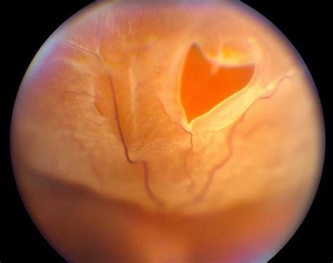 Разрывы сетчатки: причины, симптомы и методы лечения