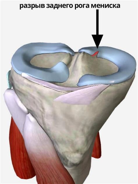 Разрыв тела медиального мениска