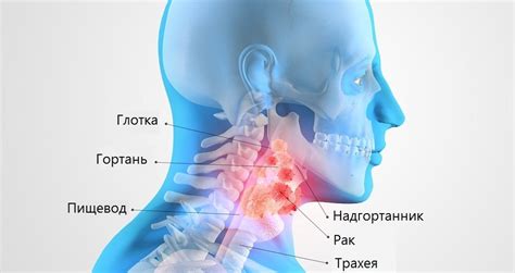 Рак горла и его симптомы