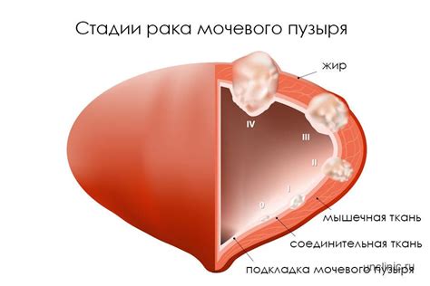 Рак мочевого пузыря