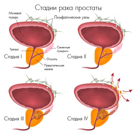 Рак предстательной железы: Прогностическая группа 4