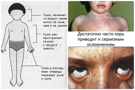 Распространение кори: почему больше 5 случаев опасно?