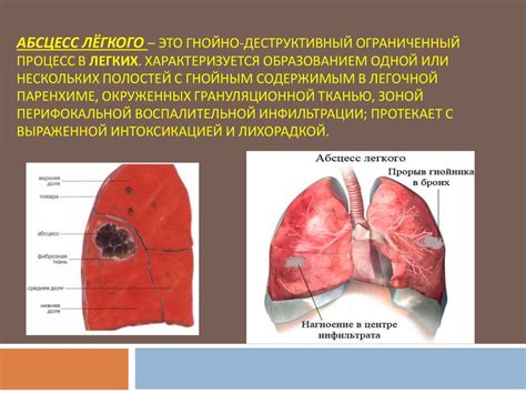 Распространение сепсиса легкого